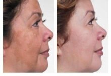 How Long Does Hydroquinone 4% Take to Show Results? A Clinical Perspective