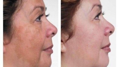 How Long Does Hydroquinone 4% Take to Show Results? A Clinical Perspective