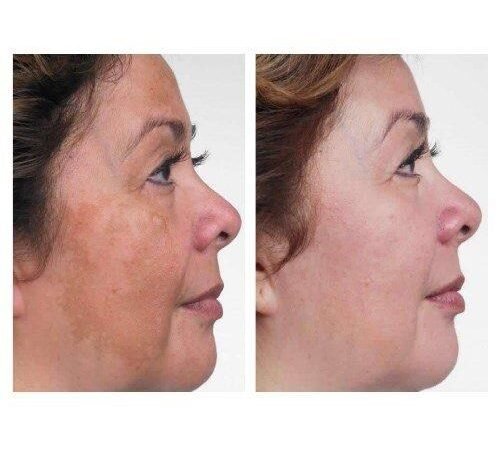 How Long Does Hydroquinone 4% Take to Show Results? A Clinical Perspective